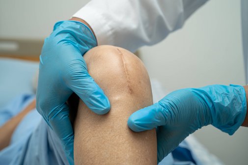 Ein Arzt oder eine Ärztin mit blauen Handschuhen untersuchen das Knie einer Patientin. Auf dem Knie sieht man eine große Narbe von einer Kniegelenks-Operation.