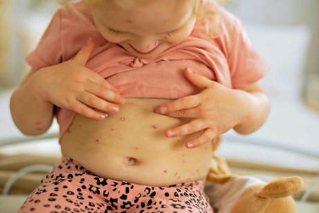 Nach der Ansteckung mit Windpocken, meist in der Kindheit, versteckt sich das Virus lebenslang in den Nervenzellen.