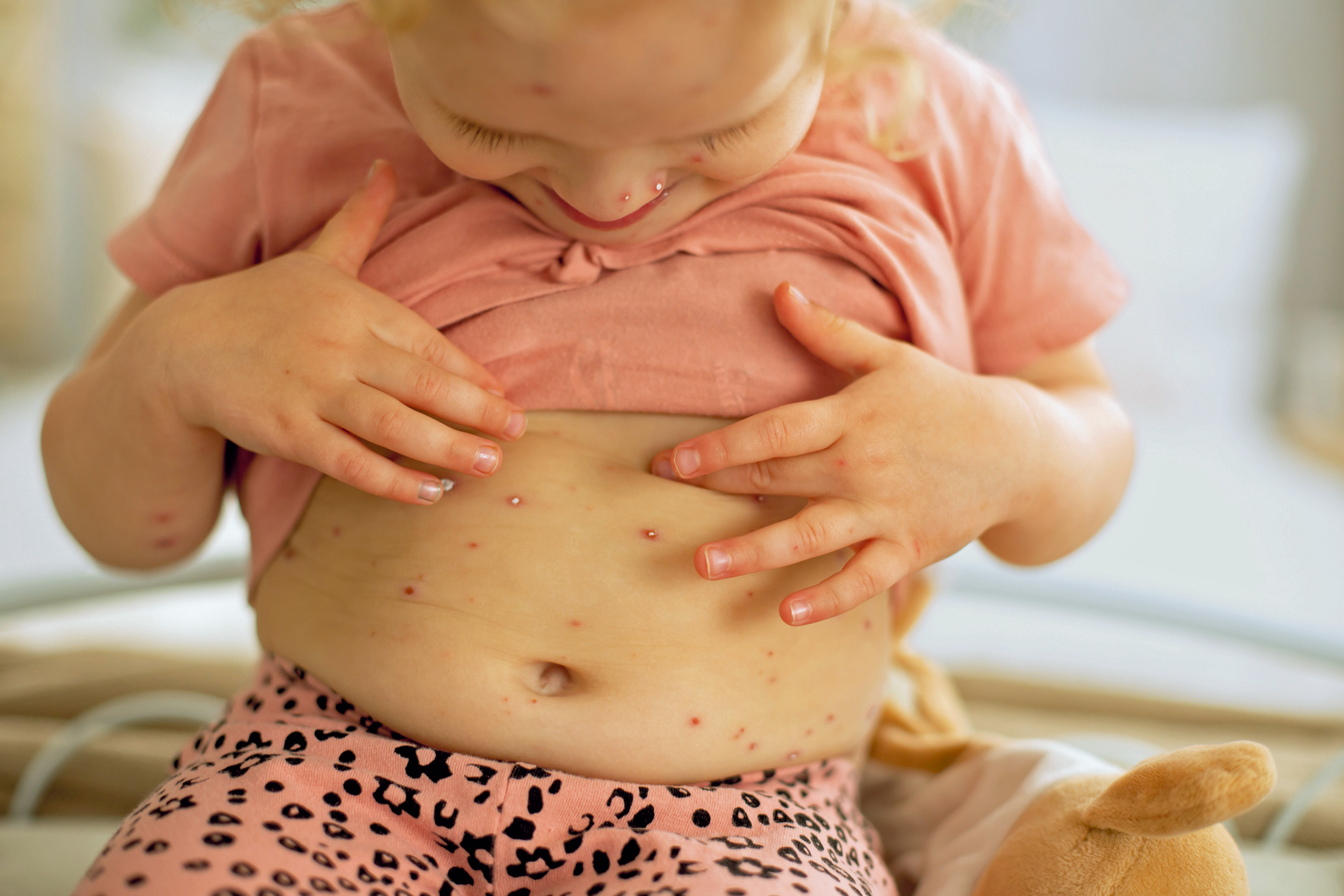 Nach der Ansteckung mit Windpocken, meist in der Kindheit, versteckt sich das Virus lebenslang in den Nervenzellen.